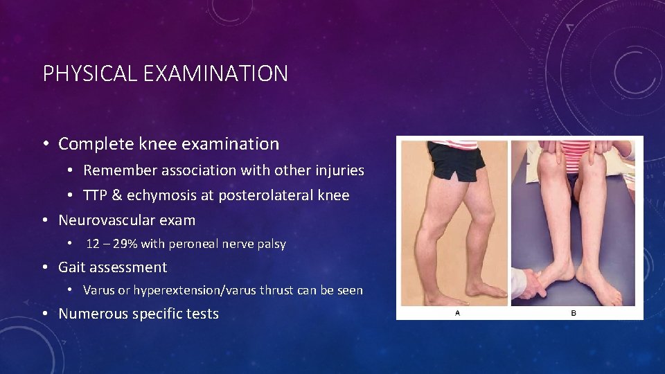 PHYSICAL EXAMINATION • Complete knee examination • Remember association with other injuries • TTP