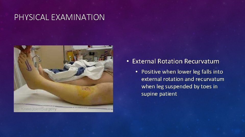 PHYSICAL EXAMINATION • External Rotation Recurvatum • Positive when lower leg falls into external