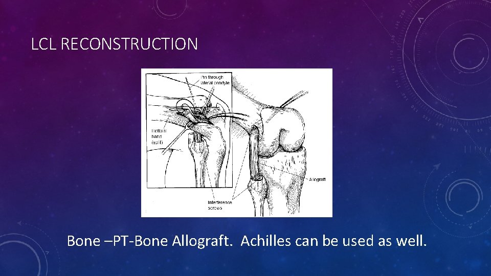 LCL RECONSTRUCTION Bone –PT-Bone Allograft. Achilles can be used as well. 