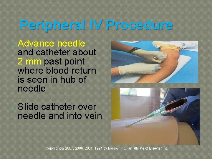 Peripheral IV Procedure �Advance needle and catheter about 2 mm past point where blood
