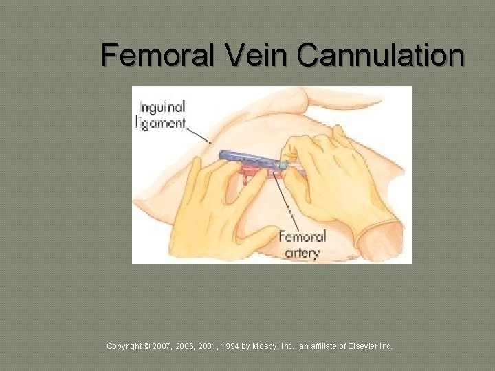 Femoral Vein Cannulation Copyright © 2007, 2006, 2001, 1994 by Mosby, Inc. , an