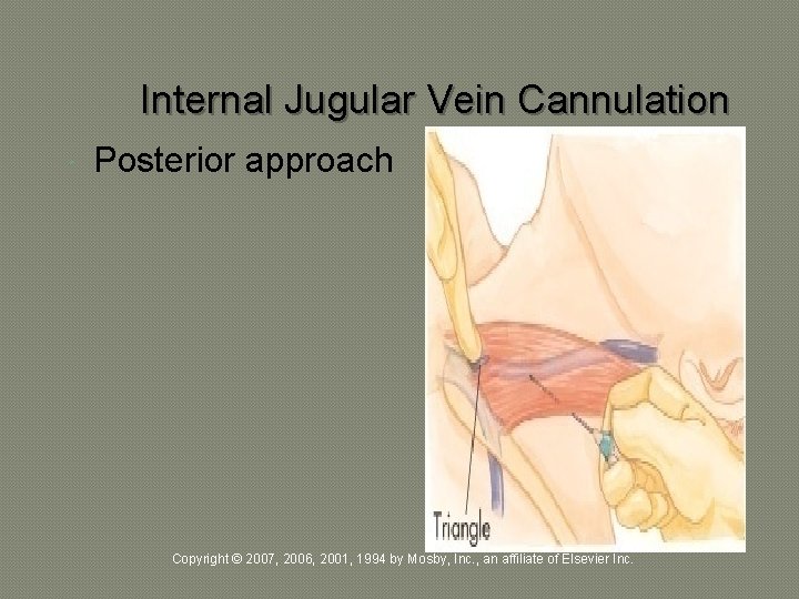 Internal Jugular Vein Cannulation Posterior approach Copyright © 2007, 2006, 2001, 1994 by Mosby,