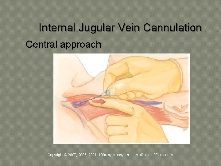 Internal Jugular Vein Cannulation Central approach Copyright © 2007, 2006, 2001, 1994 by Mosby,