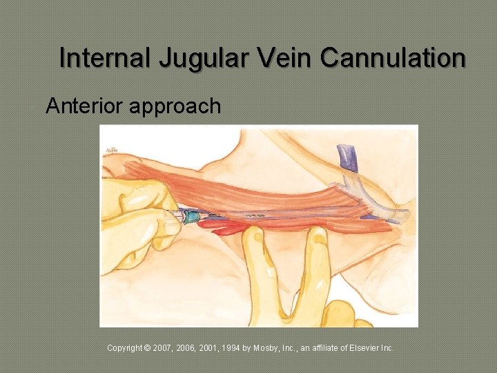 Internal Jugular Vein Cannulation Anterior approach Copyright © 2007, 2006, 2001, 1994 by Mosby,