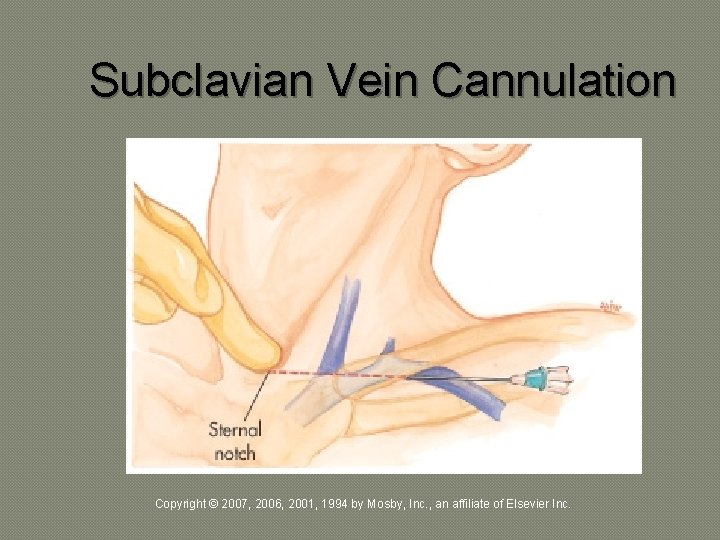 Subclavian Vein Cannulation Copyright © 2007, 2006, 2001, 1994 by Mosby, Inc. , an