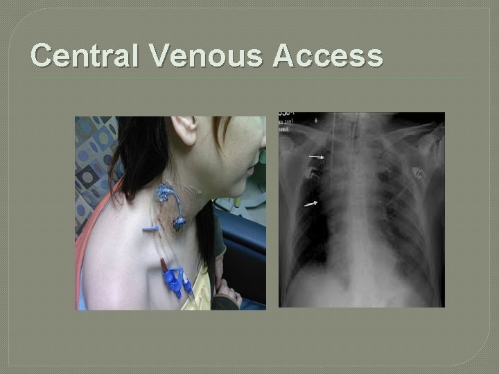 Central Venous Access 