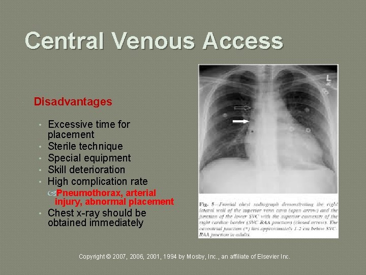 Central Venous Access Disadvantages • Excessive time for • • placement Sterile technique Special