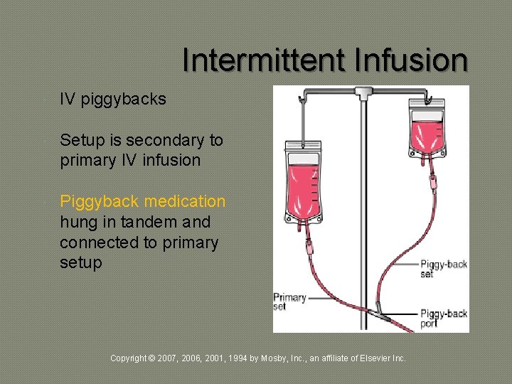 Intermittent Infusion IV piggybacks Setup is secondary to primary IV infusion Piggyback medication hung