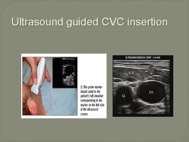 Ultrasound guided CVC insertion 