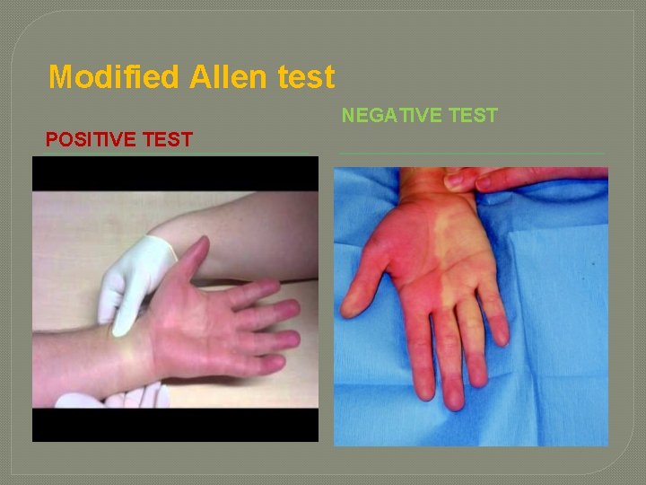 Modified Allen test NEGATIVE TEST POSITIVE TEST 