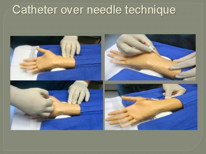 Catheter over needle technique Catheter over needle technique