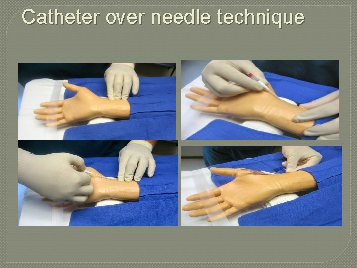 Catheter over needle technique 