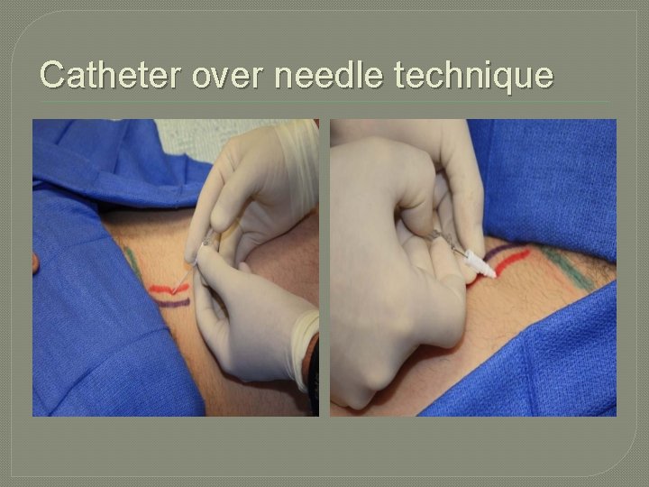 Catheter over needle technique 