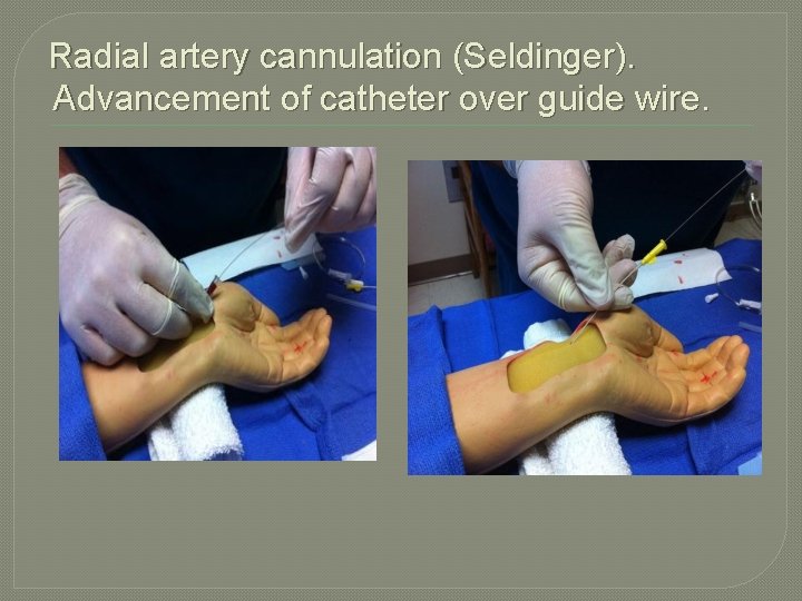 Radial artery cannulation (Seldinger). Advancement of catheter over guide wire. 