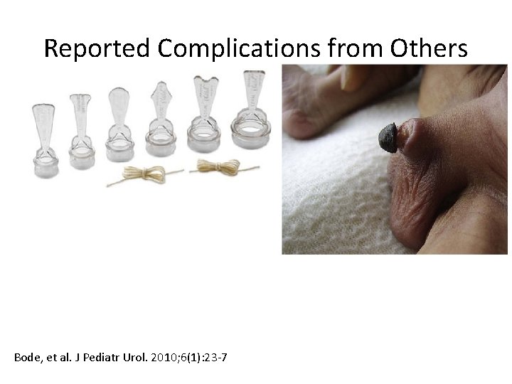 Reported Complications from Others Bode, et al. J Pediatr Urol. 2010; 6(1): 23 -7 Reported Complications from Others Bode, et al. J Pediatr Urol. 2010; 6(1): 23 -7