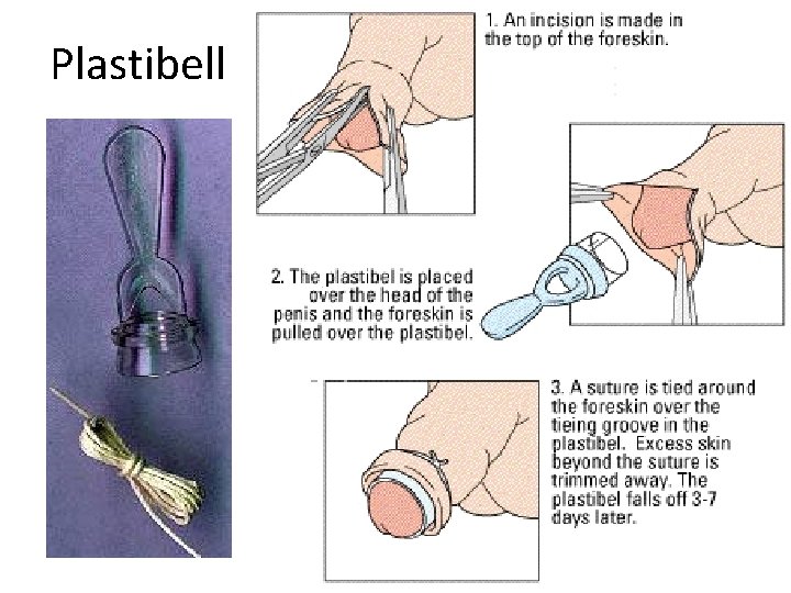 Plastibell Plastibell