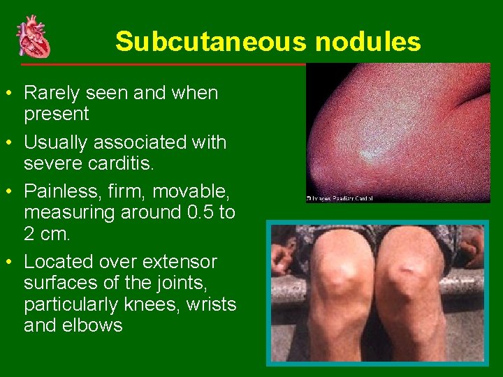 Subcutaneous nodules • Rarely seen and when present • Usually associated with severe carditis.