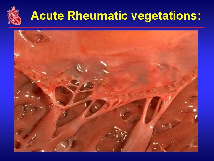 Acute Rheumatic vegetations: 