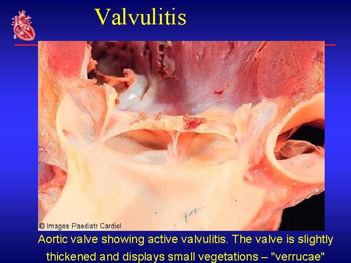 Valvulitis Aortic valve showing active valvulitis. The valve is slightly thickened and displays small