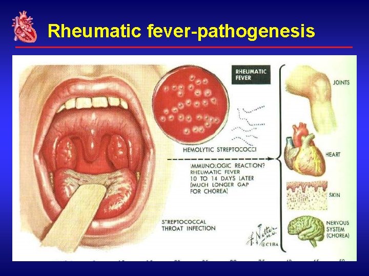 Rheumatic fever-pathogenesis 