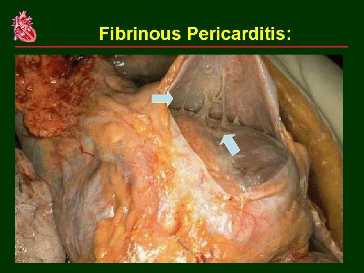 Fibrinous Pericarditis: 