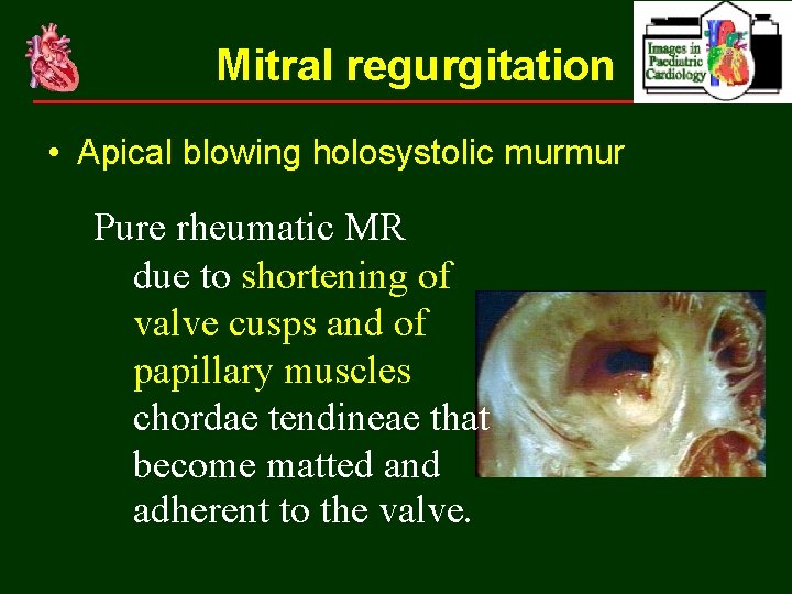 Mitral regurgitation • Apical blowing holosystolic murmur Pure rheumatic MR due to shortening of