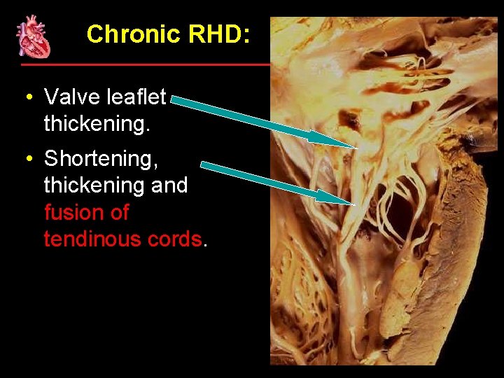 Chronic RHD: • Valve leaflet thickening. • Shortening, thickening and fusion of tendinous cords.
