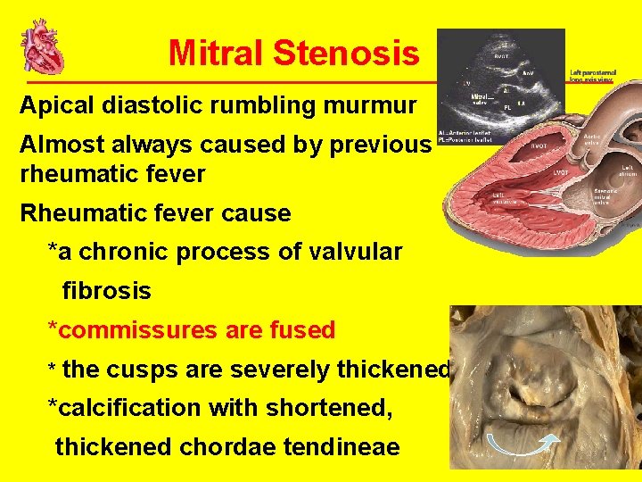 Mitral Stenosis • Apical diastolic rumbling murmur • Almost always caused by previous rheumatic