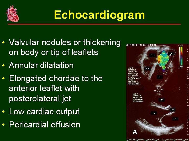 Echocardiogram • Valvular nodules or thickening on body or tip of leaflets • Annular