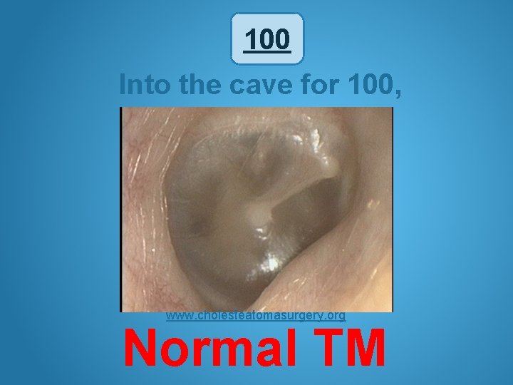 100 Into the cave for 100, www. cholesteatomasurgery. org Normal TM 