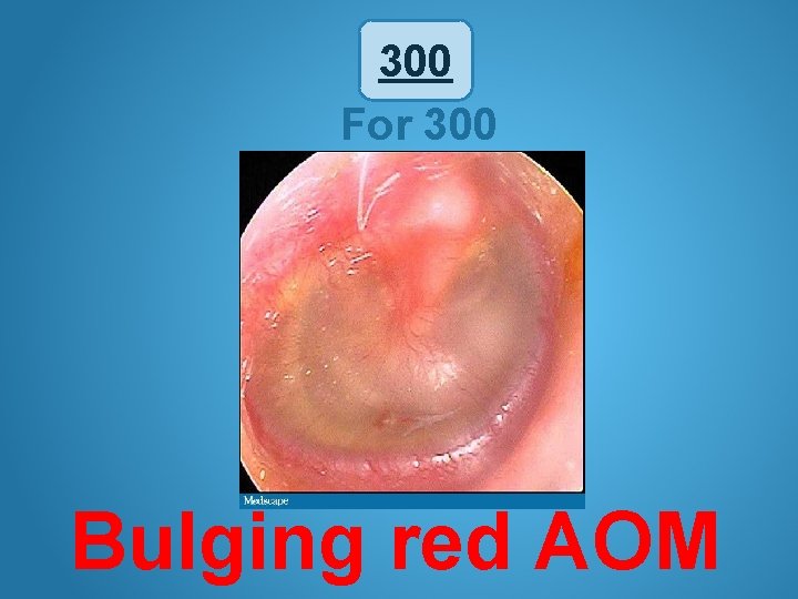 300 For 300 Bulging red AOM 