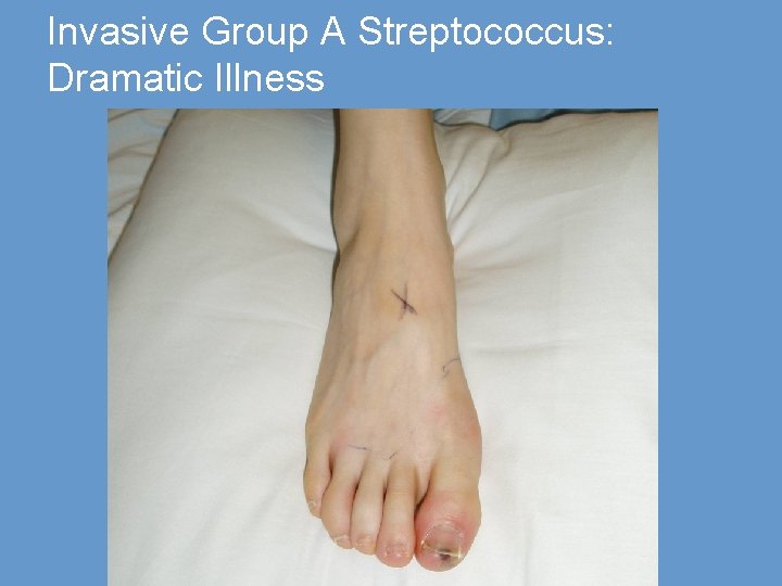 Invasive Group A Streptococcus: Dramatic Illness 