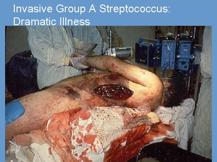 Invasive Group A Streptococcus: Dramatic Illness 