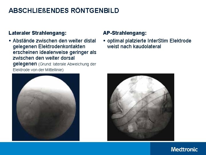 ABSCHLIEßENDES RÖNTGENBILD Lateraler Strahlengang: § Abstände zwischen den weiter distal gelegenen Elektrodenkontakten erscheinen idealerweise