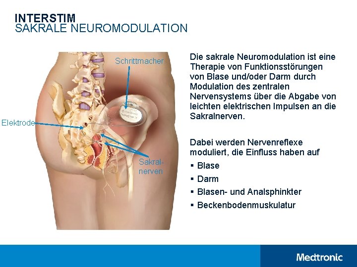 INTERSTIM SAKRALE NEUROMODULATION Schrittmacher Elektrode Sakralnerven Die sakrale Neuromodulation ist eine Therapie von Funktionsstörungen