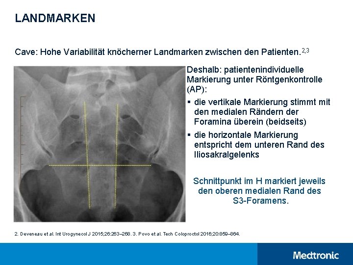 LANDMARKEN Cave: Hohe Variabilität knöcherner Landmarken zwischen den Patienten. 2, 3 Deshalb: patientenindividuelle Markierung