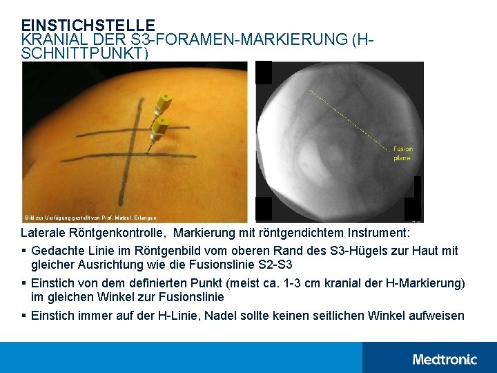 EINSTICHSTELLE KRANIAL DER S 3 -FORAMEN-MARKIERUNG (HSCHNITTPUNKT) Bild zur Verfügung gestellt von Prof. Matzel, EINSTICHSTELLE KRANIAL DER S 3 -FORAMEN-MARKIERUNG (HSCHNITTPUNKT) Bild zur Verfügung gestellt von Prof. Matzel,