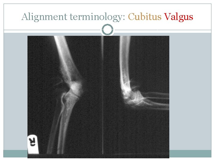 Alignment terminology: Cubitus Valgus 