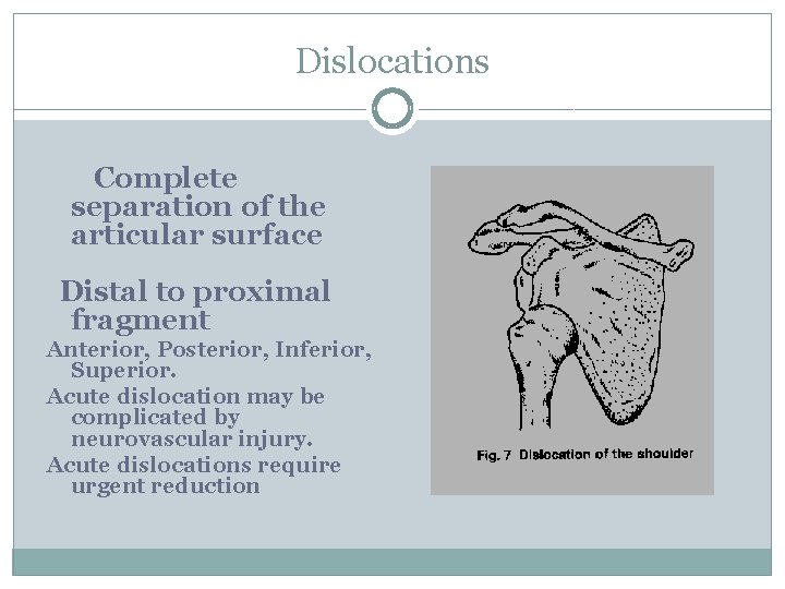 Dislocations Complete separation of the articular surface Distal to proximal fragment Anterior, Posterior, Inferior,