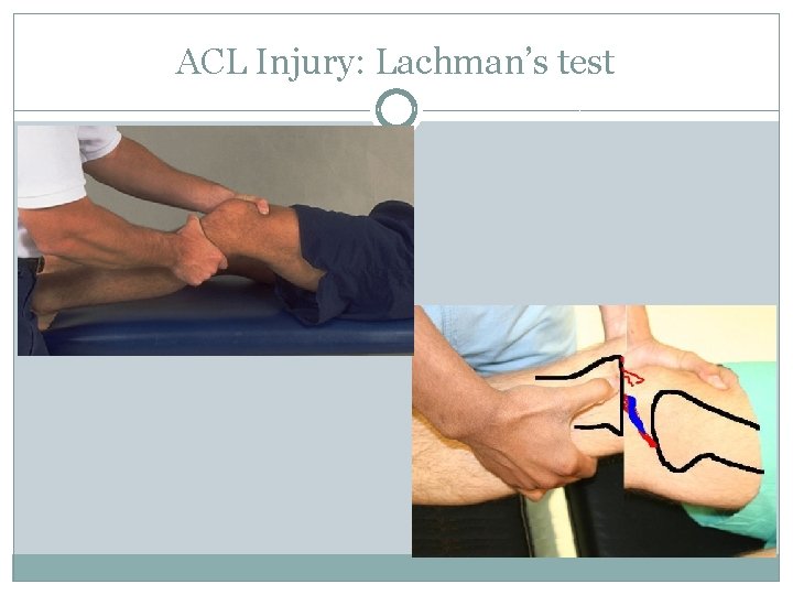 ACL Injury: Lachman’s test 