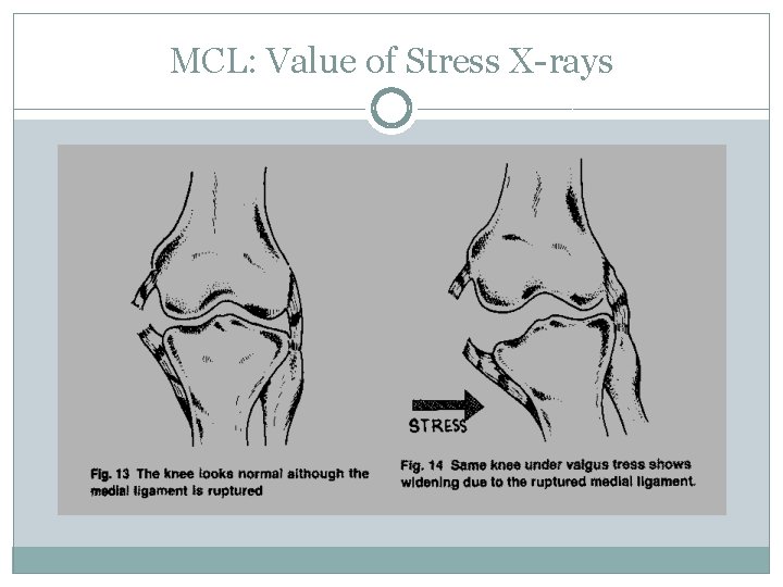 MCL: Value of Stress X-rays 