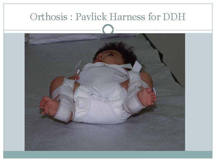 Orthosis : Pavlick Harness for DDH 