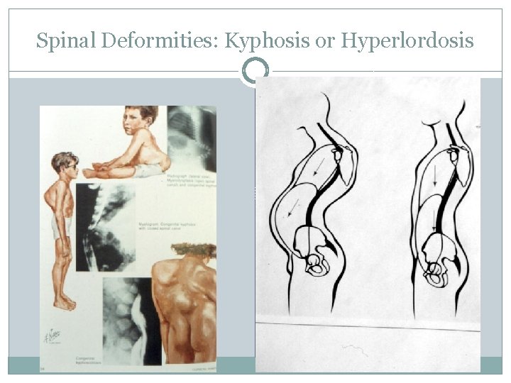 Spinal Deformities: Kyphosis or Hyperlordosis 