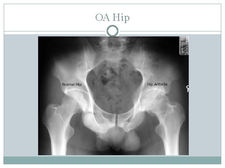 OA Hip 