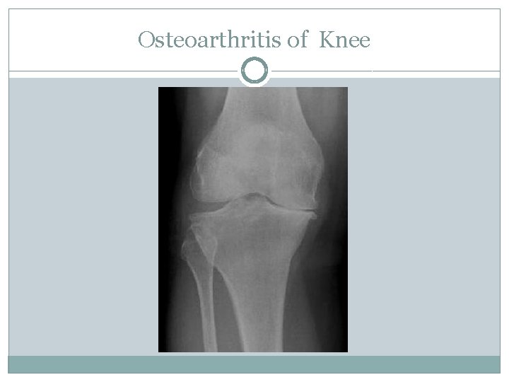 Osteoarthritis of Knee 