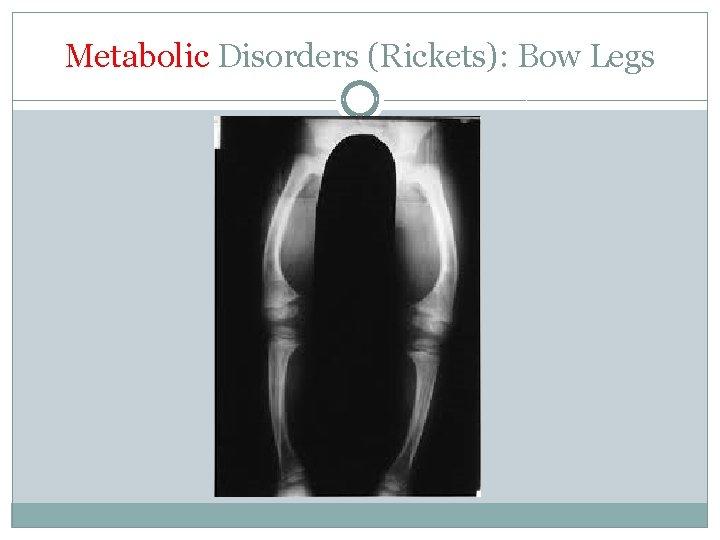 Metabolic Disorders (Rickets): Bow Legs 