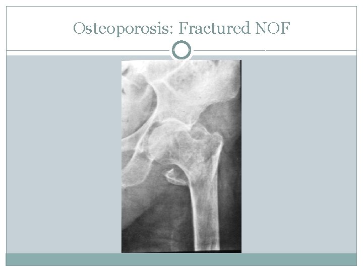 Osteoporosis: Fractured NOF 