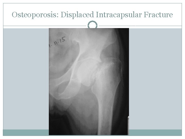 Osteoporosis: Displaced Intracapsular Fracture 
