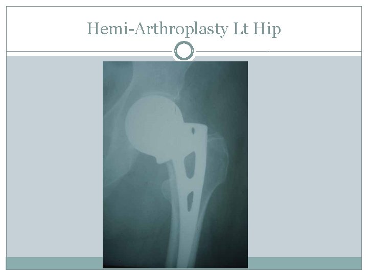 Hemi-Arthroplasty Lt Hip 