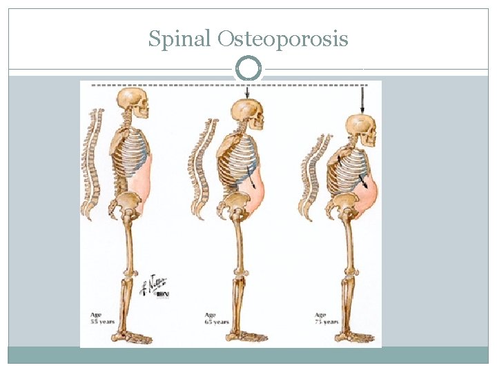 Spinal Osteoporosis 